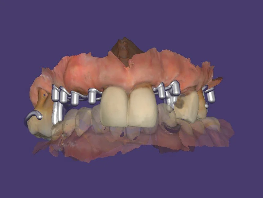 Digitally Designed Dentures: A Stronger Approach for Patients with a Heavy Bite