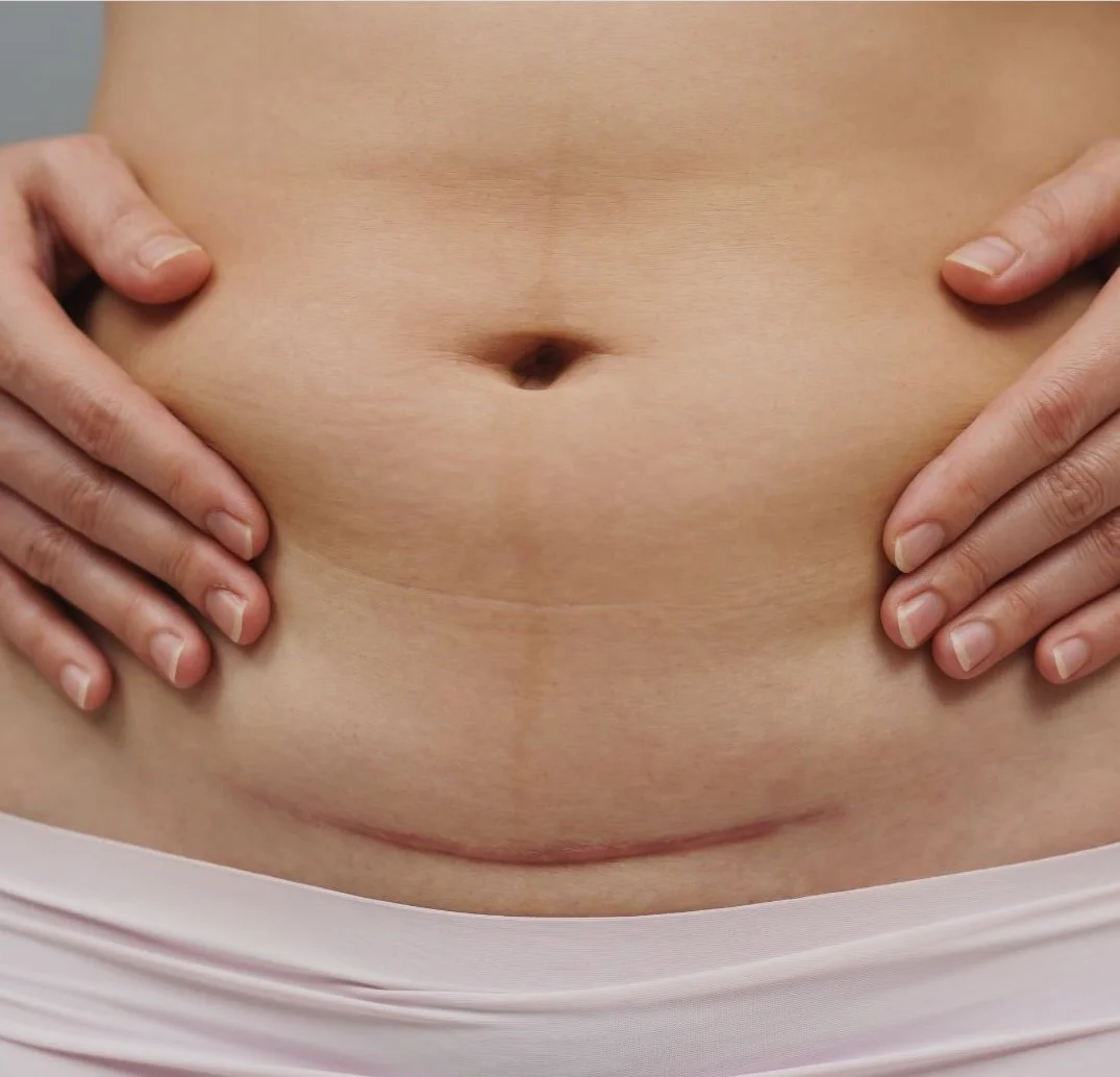 C-Section Scar Massage: Why It Matters and When to Start