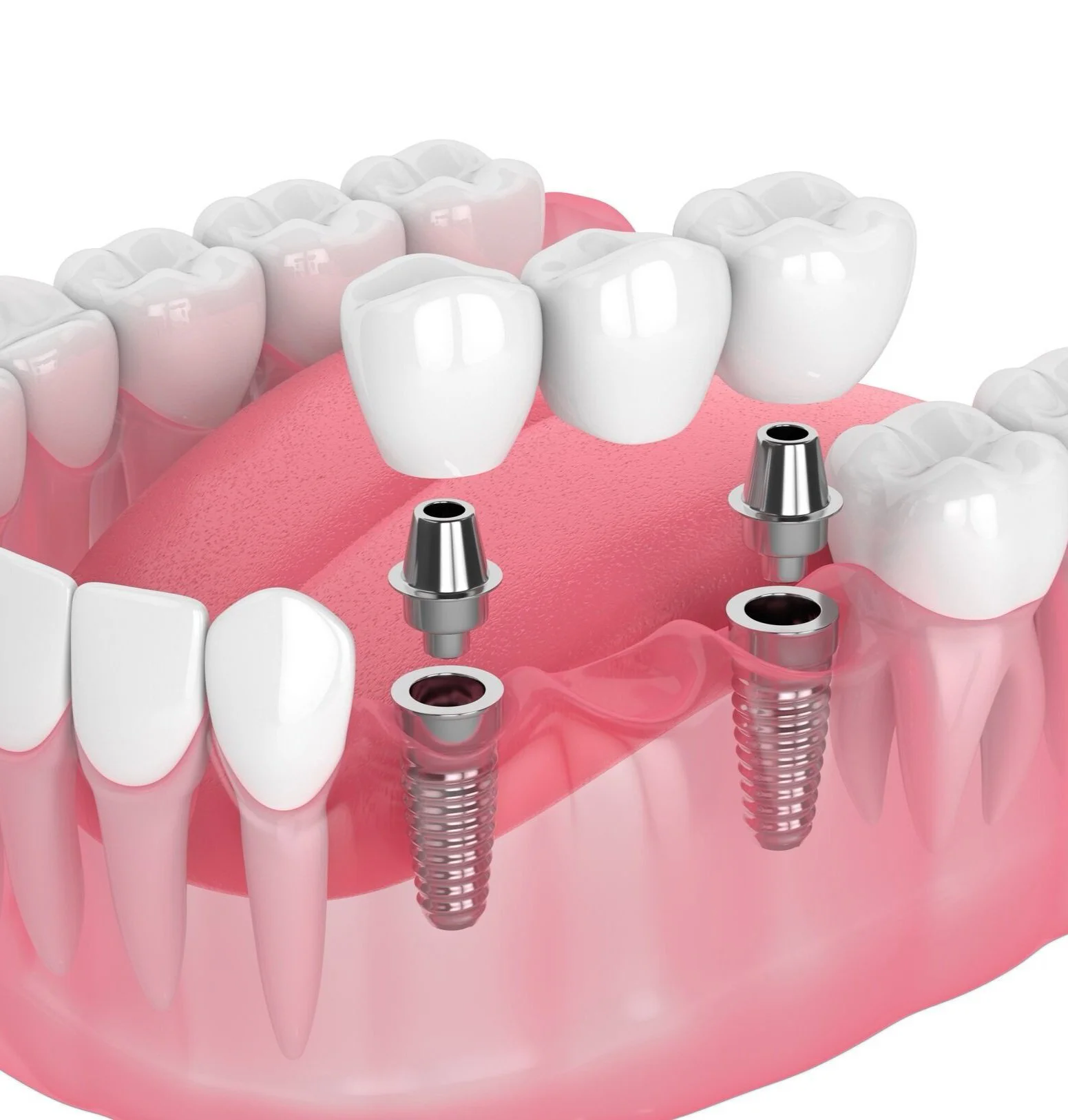 What Happens If You Leave a Missing Tooth Untreated
