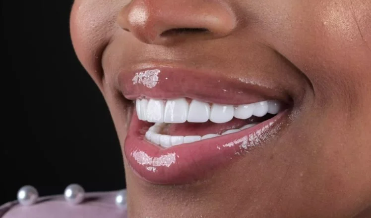 Porcelain veneers smile by the expert clinicians at Whitefield Dental