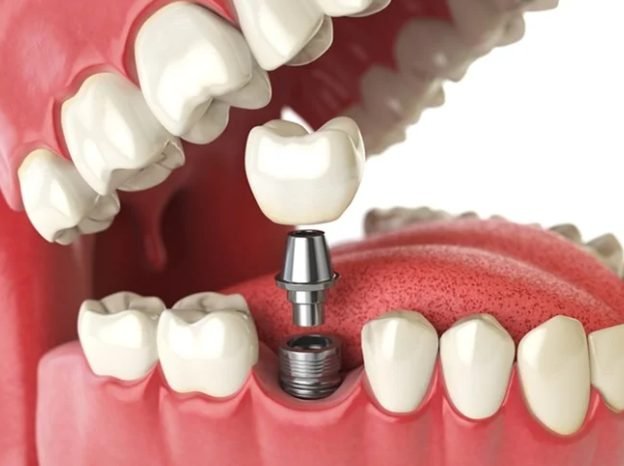 Dental implant crown and abutment, dental implants in Whitefield, Manchester