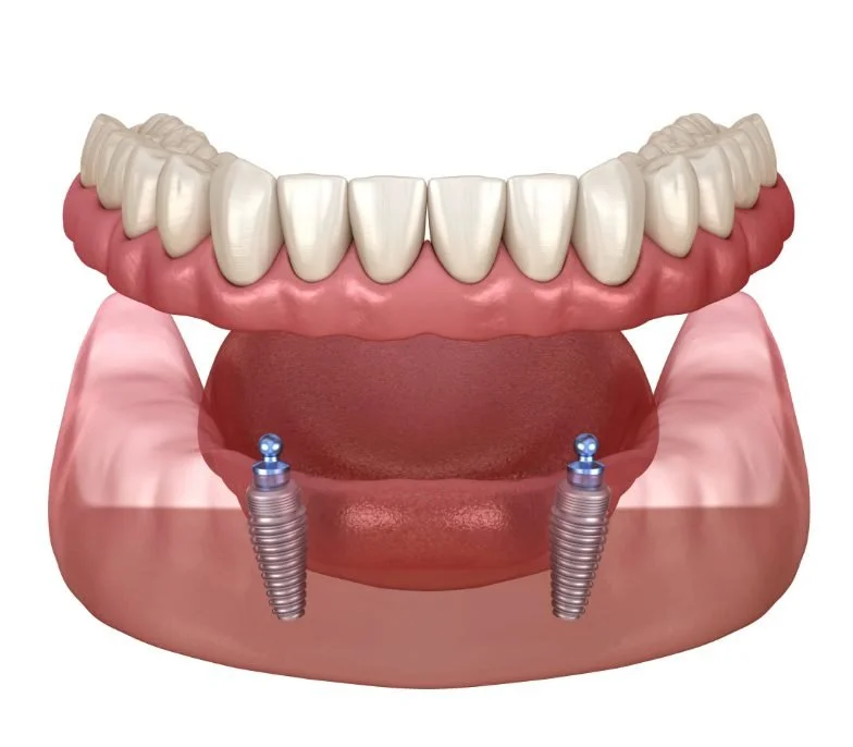 Implant retained denture held by two dental implants