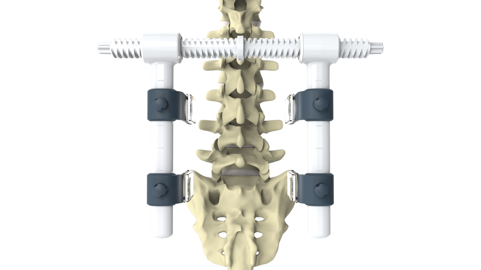 Lumbar Retractor - Setup.png