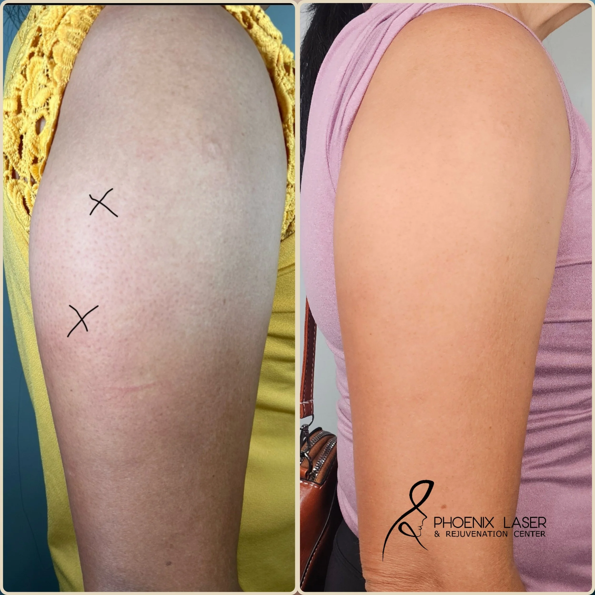 lipo disolve