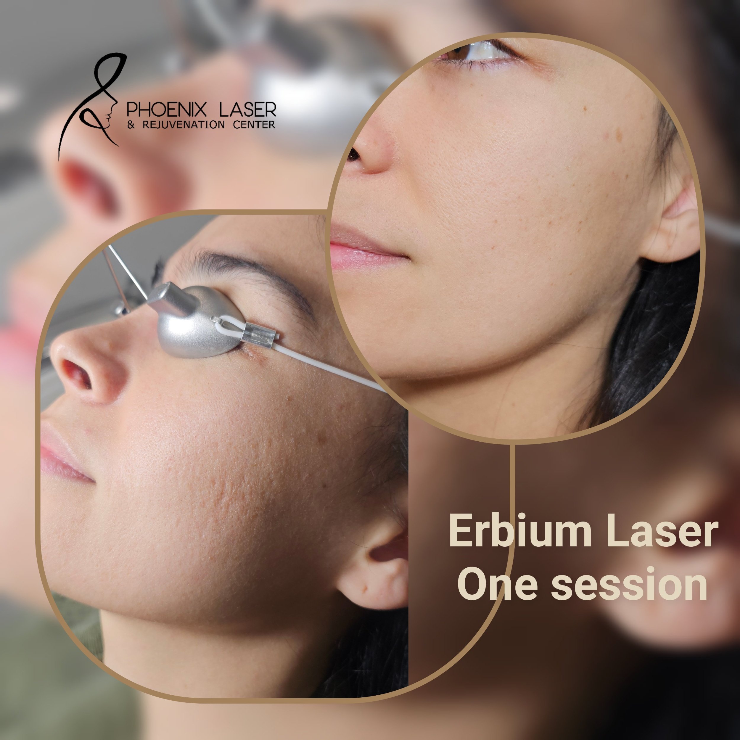 acne scar removal with erbium