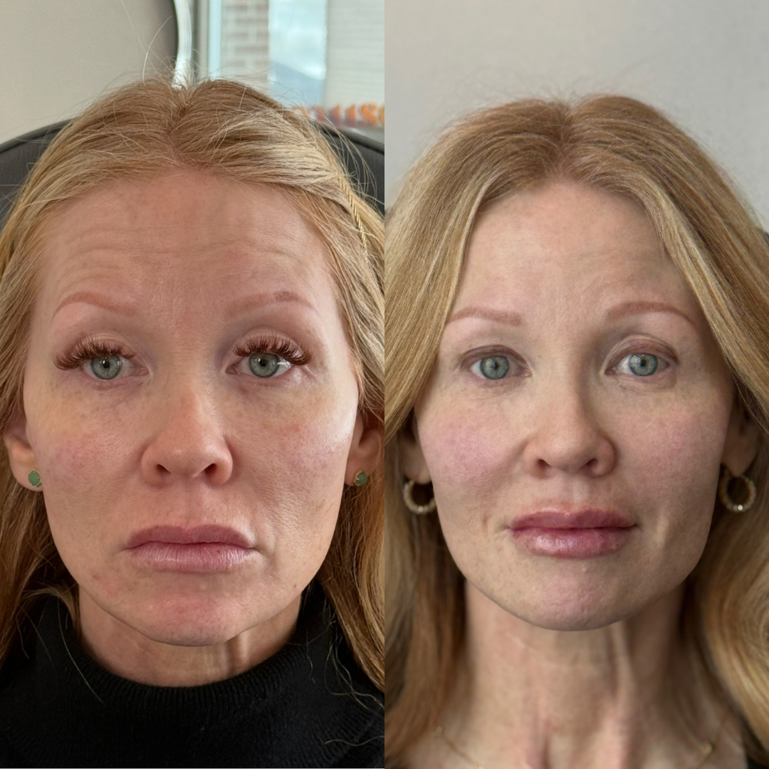 LIFTED, SCULPTED, FACE TRANSFORMATION, XEOMIN, FACE REJUVENATION
