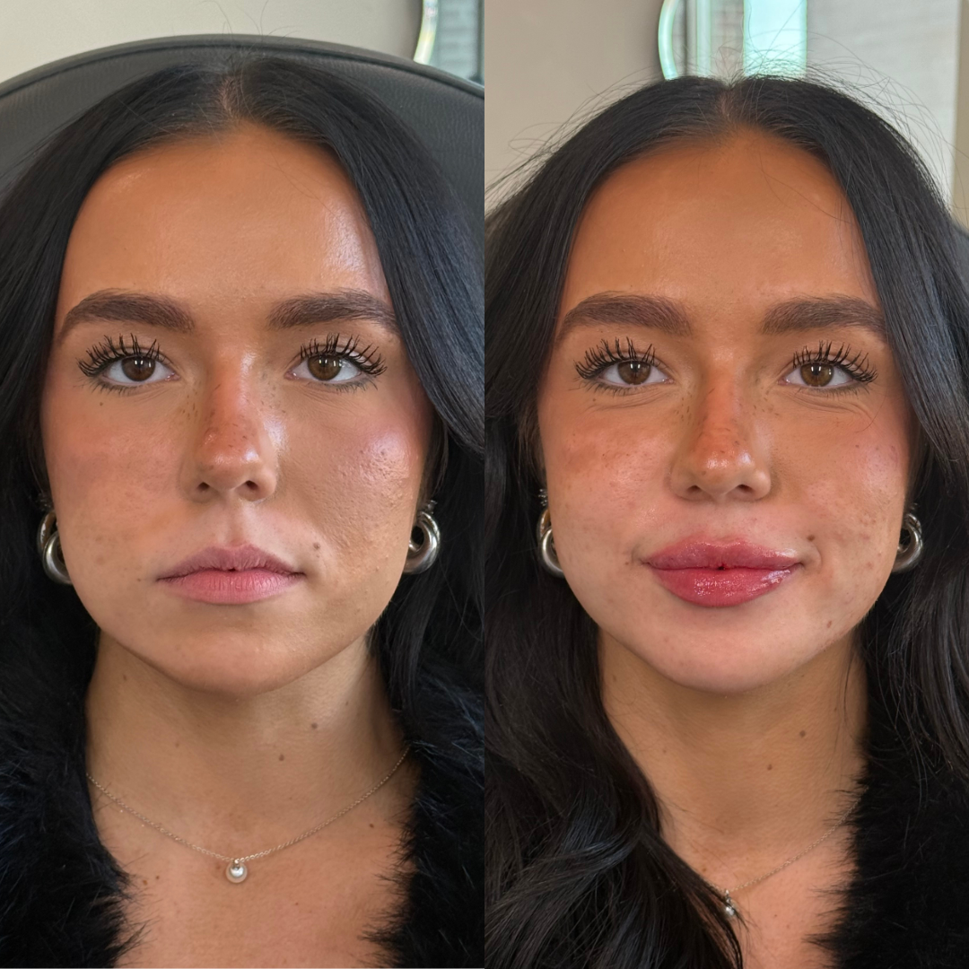 Side-by-side comparison of a woman with clear skin on the left and with slightly more visible freckles and a shiny lip gloss on the right. lip injections before and after chesterton indiana