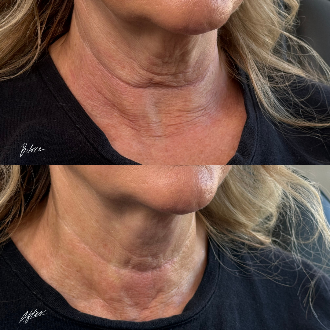 neck radiesse, hormone replacement, holistic medicine, functional medicine muse med spa