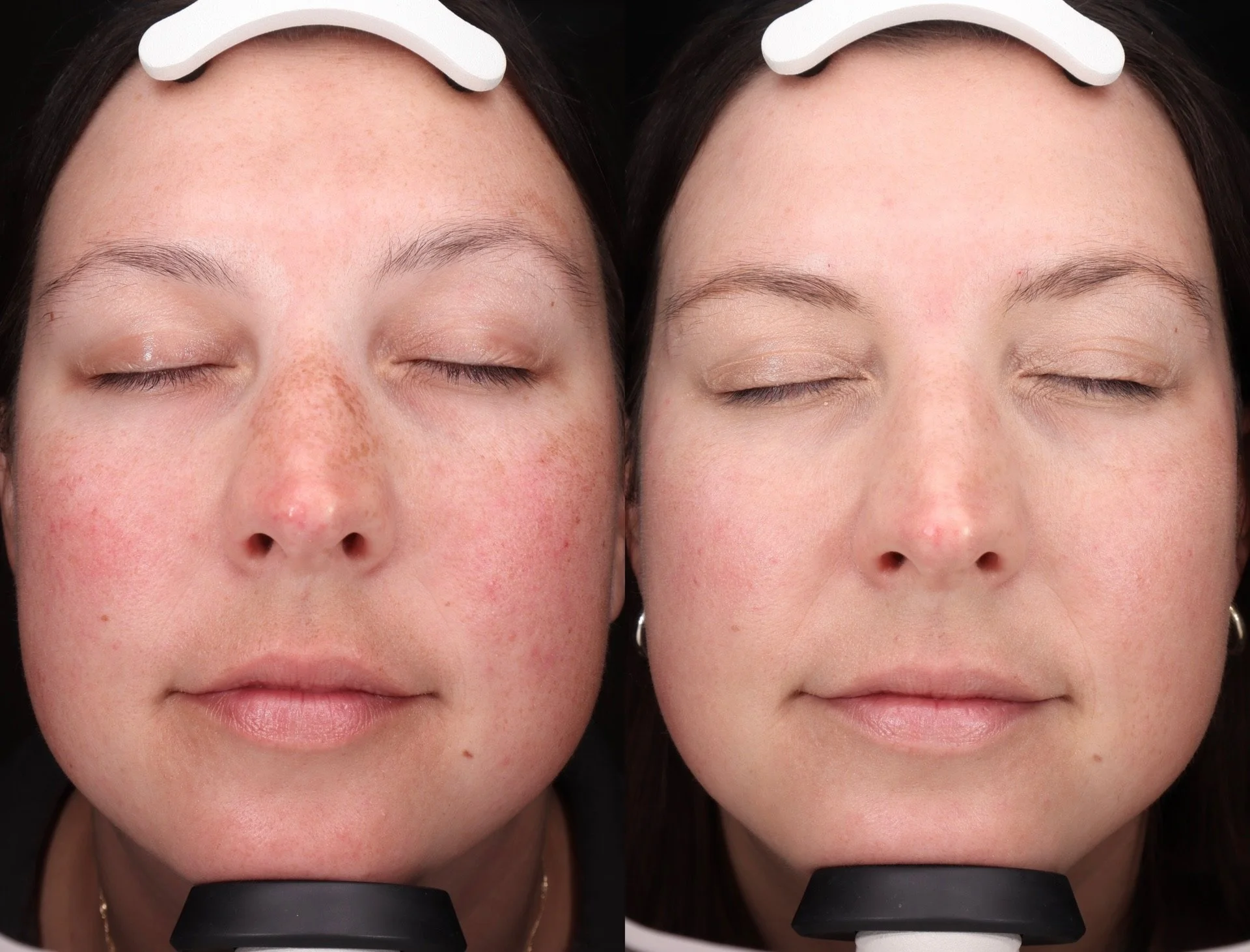 BBL BEFORE AND AFTER, laser treatment, skin rejuvenation