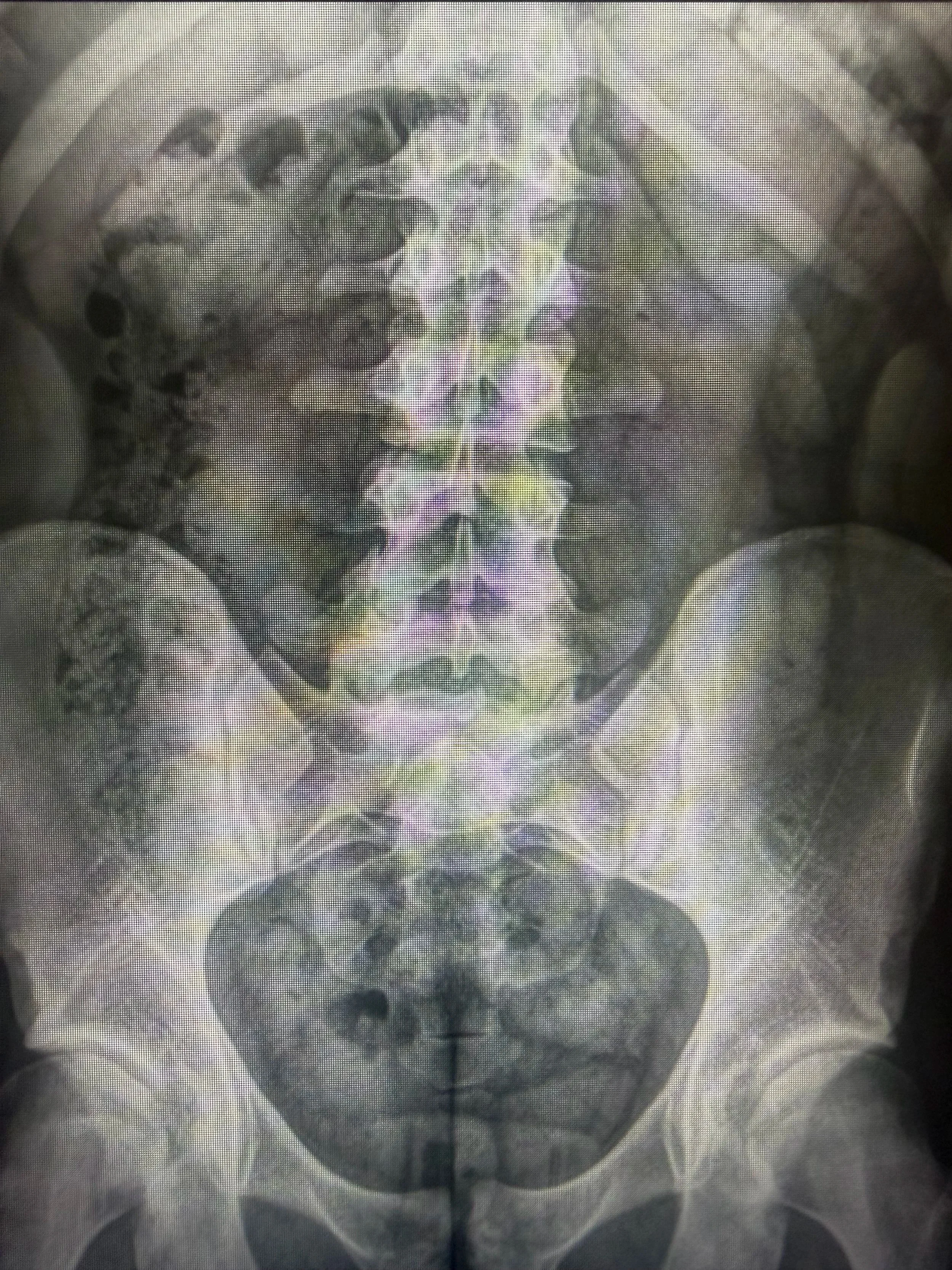Do I Need an X-Ray for Back Pain? What Chiropractors Look For