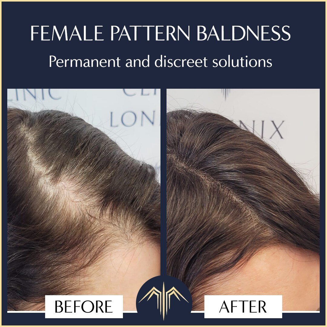 Women suffer hair loss for a variety of reasons. Stress, underlying health issues, a change in hormones or just simply the ageing process can all affect the thickness of your hair.

Scalp Micropigmentation can help restore the appearance of fuller ha