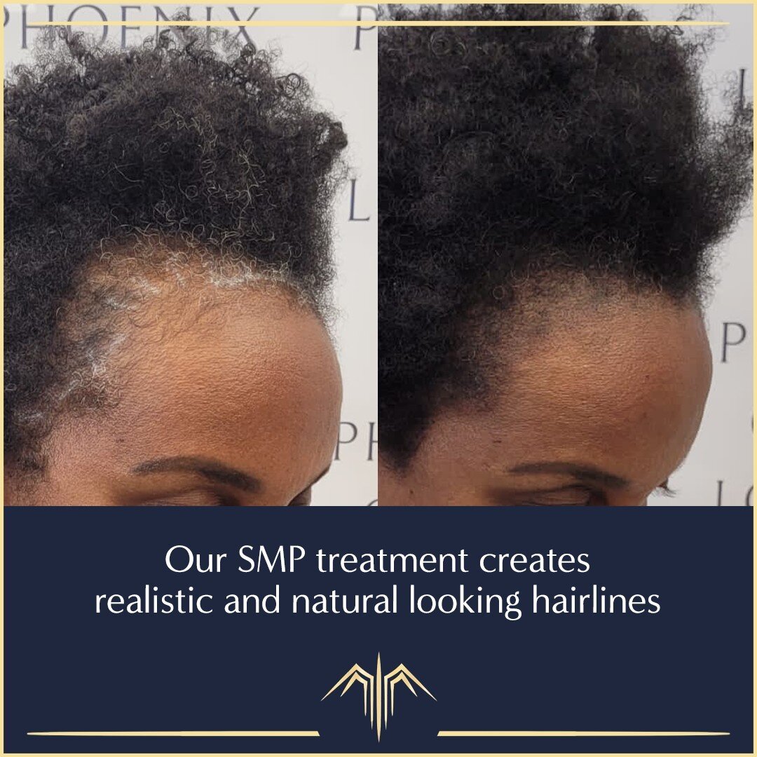 At Phoenix Clinic London, we are renowned for our natural-looking hairlines. 

Even up close, the results are so realistic, the treatment is indistinguishable from real hair. 

Book your no-obligation free consultation today. 
.
.
.
#phoenixcliniclon