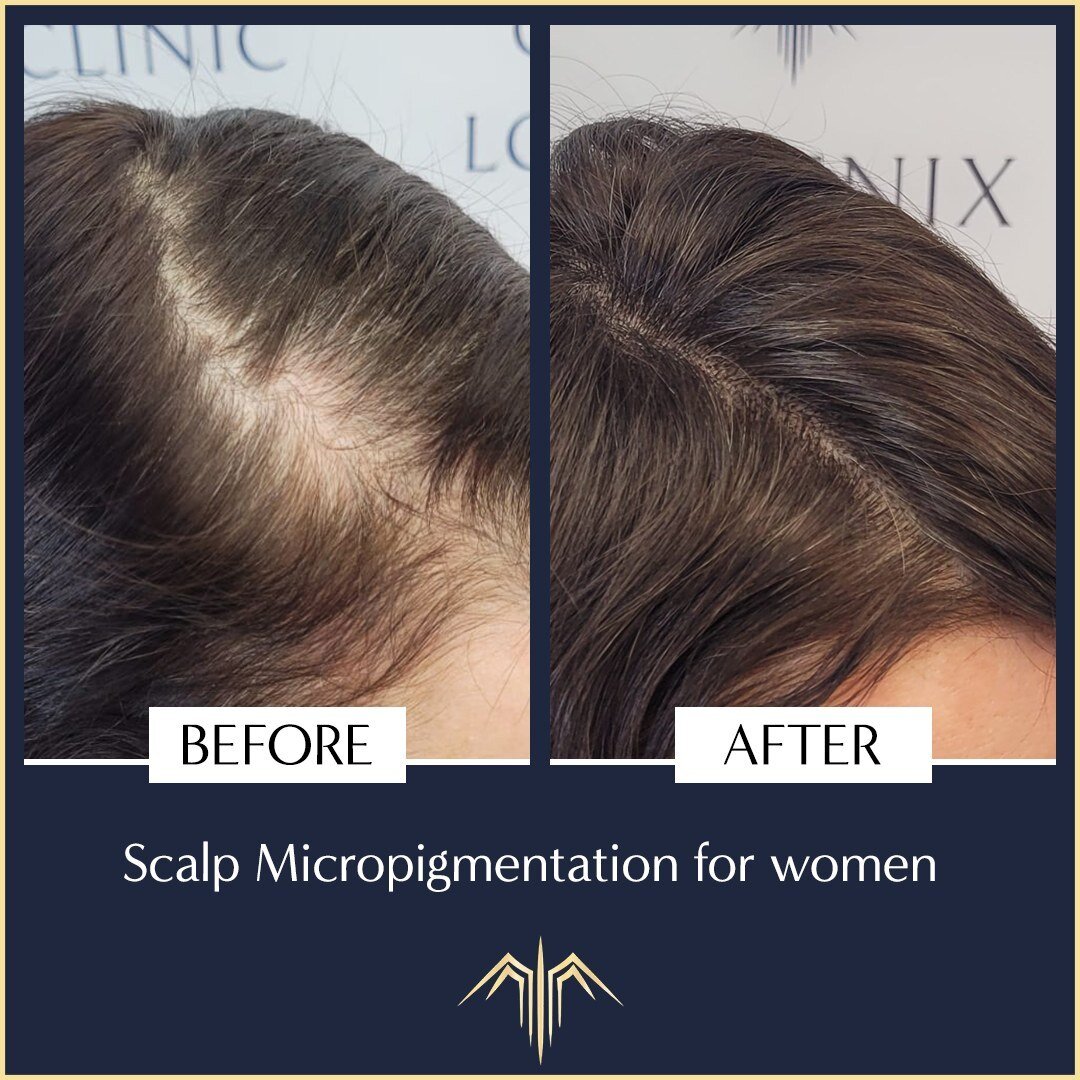 Hair Scalp Micropigmentation (SMP) for women, makes hair look thicker and fuller. It&rsquo;s a treatment that disguises thinning, receding or patchy hair and will prevent the scalp from being immediately seen.

Read more about SMP on our website and 