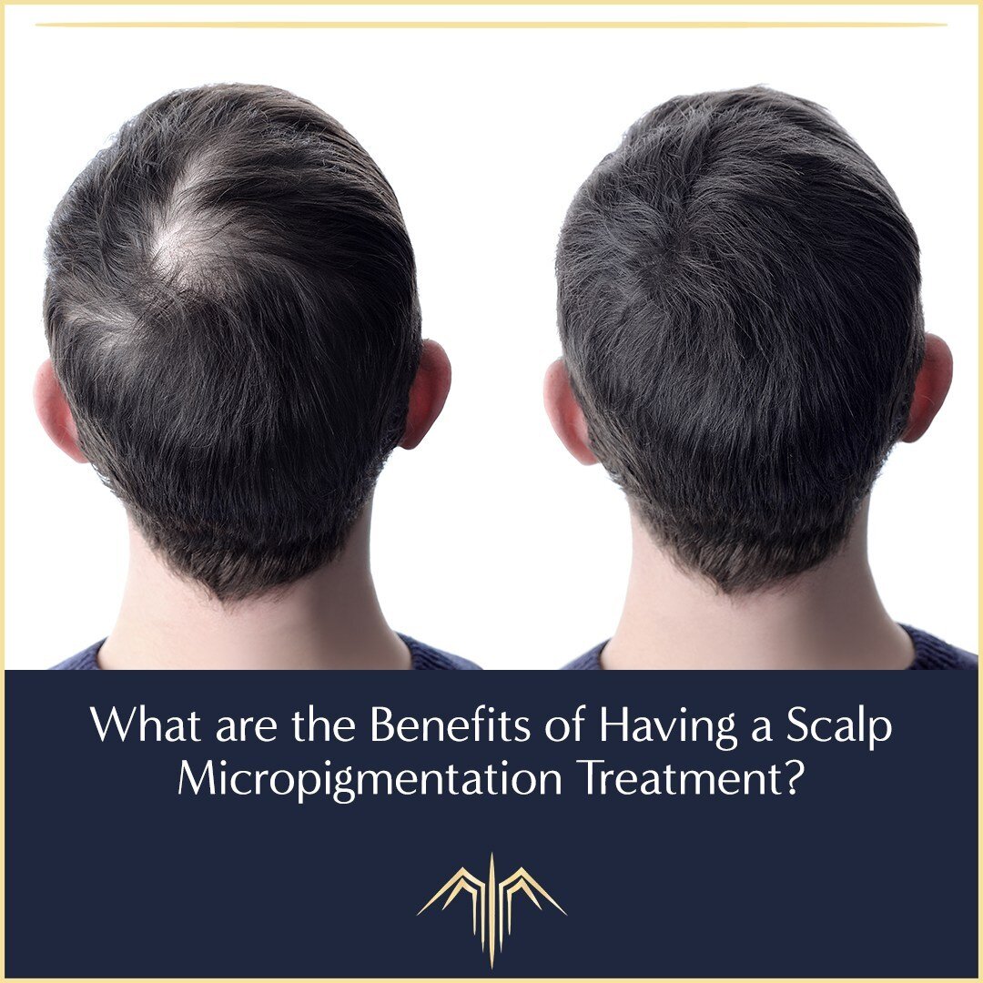 The benefits of having a Scalp Micropigmentation Treatment include:
 
▪ The appearance of a full head of shaved hair or a fresh buzz cut.
▪ Restore hairline for all types and levels of baldness.
▪ Camouflages bald spots, thinning patches and old scar