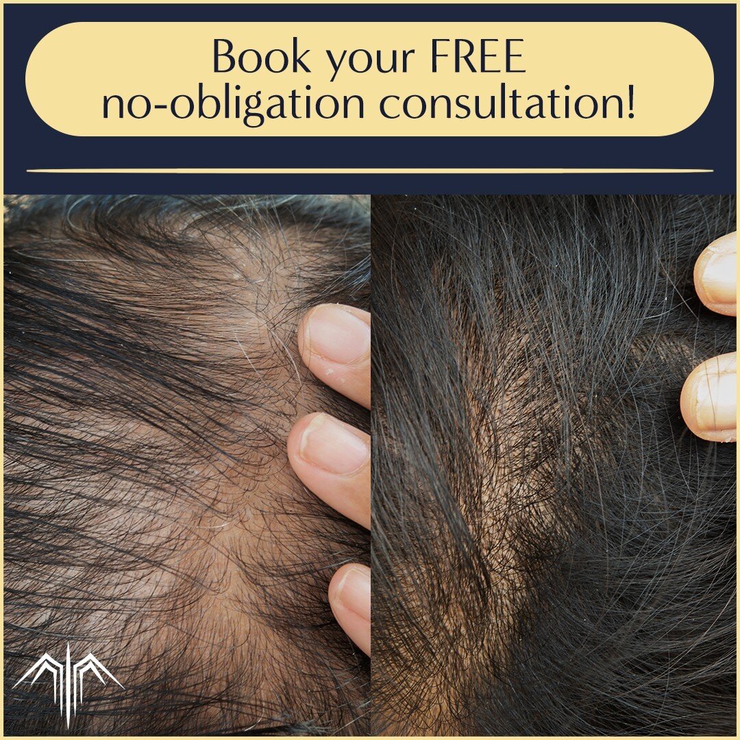 Density in thinning hair is achieved by building up multiple shades of micro-dots around and in between the existing hair follicles. 

This is performed over several sessions.

Book your no-obligation free consultation today! 
.
.
.
#phoenixcliniclon