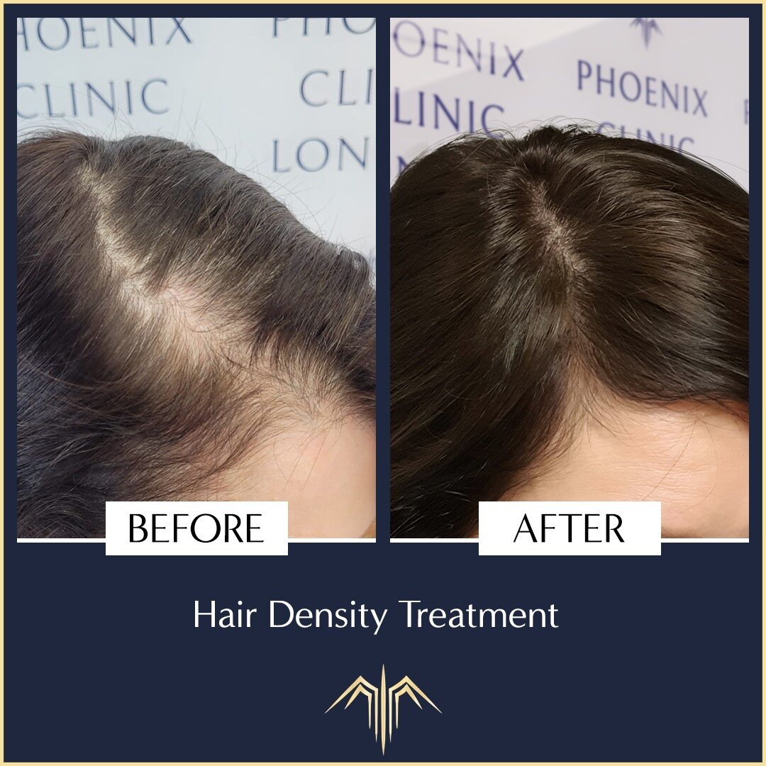 There is nothing we love more than helping you restore your confidence and self-esteem!

Contact us to book your free consultation. 
.
.
.
#phoenixcliniclondon #hairlosssolution #smp #SMPtreatment #scalpmicopigmentation #smphair #smphairtattoo #smpha