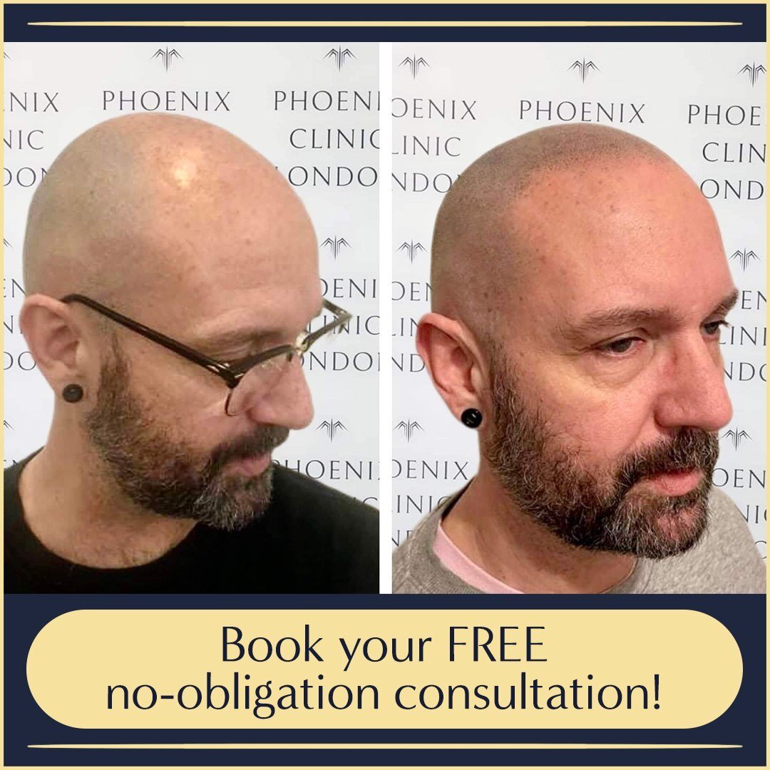 How good do these results look?!

Don't forget your initial consultation is FREE with no obligation. 

Enquire today. 
.
.
.
#phoenixcliniclondon #hairlosssolution #smp #SMPtreatment #scalpmicopigmentation #smphair #smphairtattoo #smphairsolutions #s