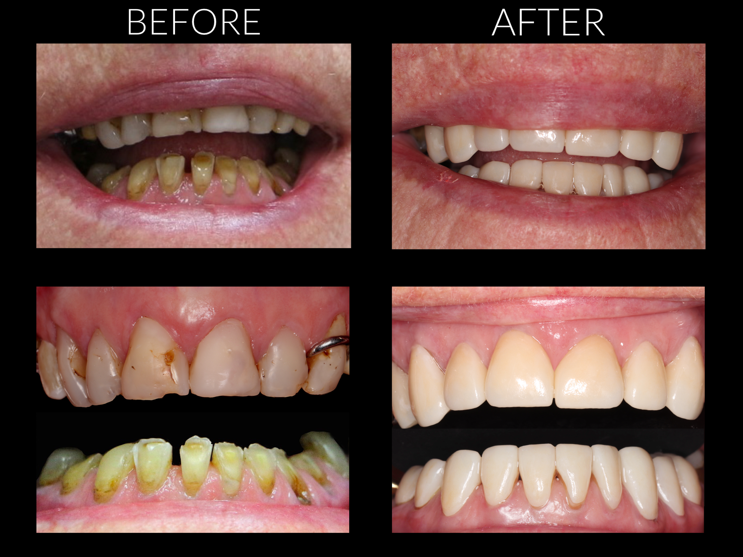 Worn down teeth restored with porcelain crowns to bring back chewing function and esthetics.