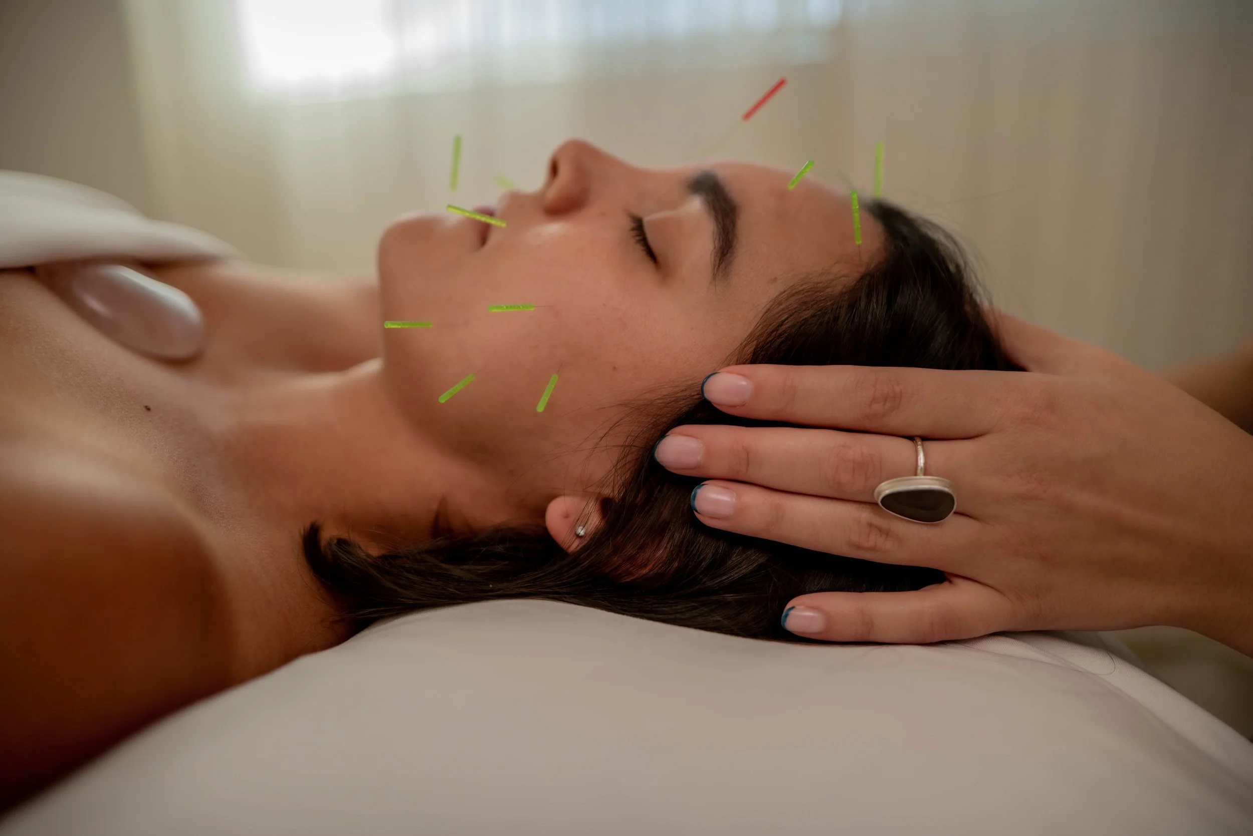 Woman receiving acupuncture on face.