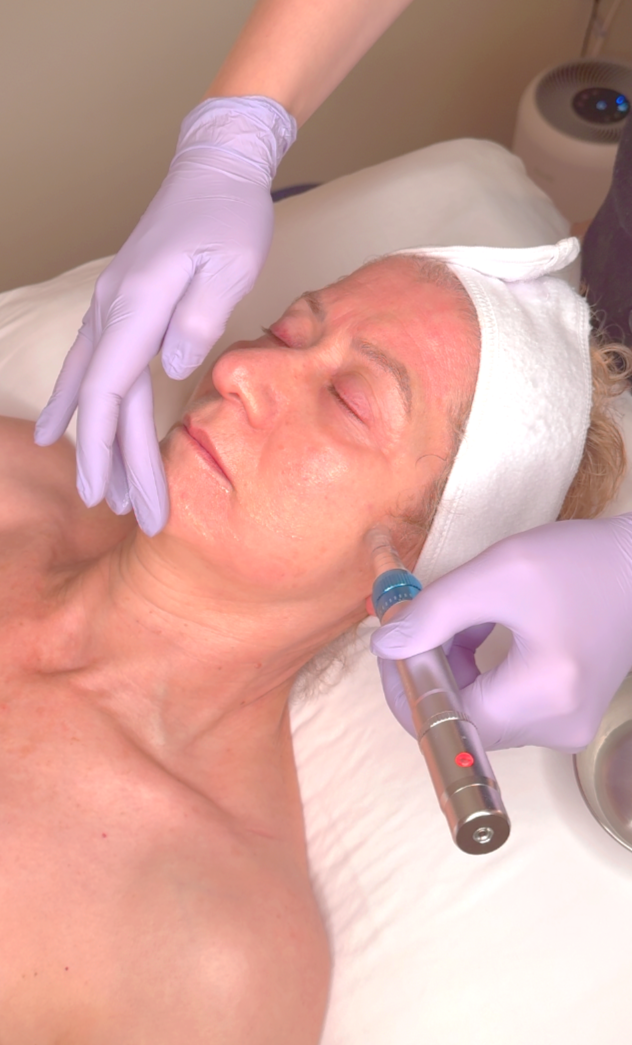 Microneedling ritual with body acupuncture for women in Montrose, California