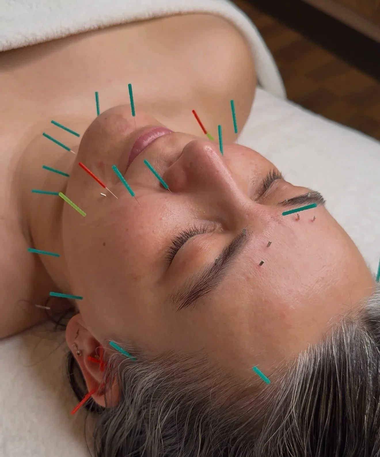 Facial rejuvenation acupuncture treatment supporting healthy aging, circulation, and natural skin vitality