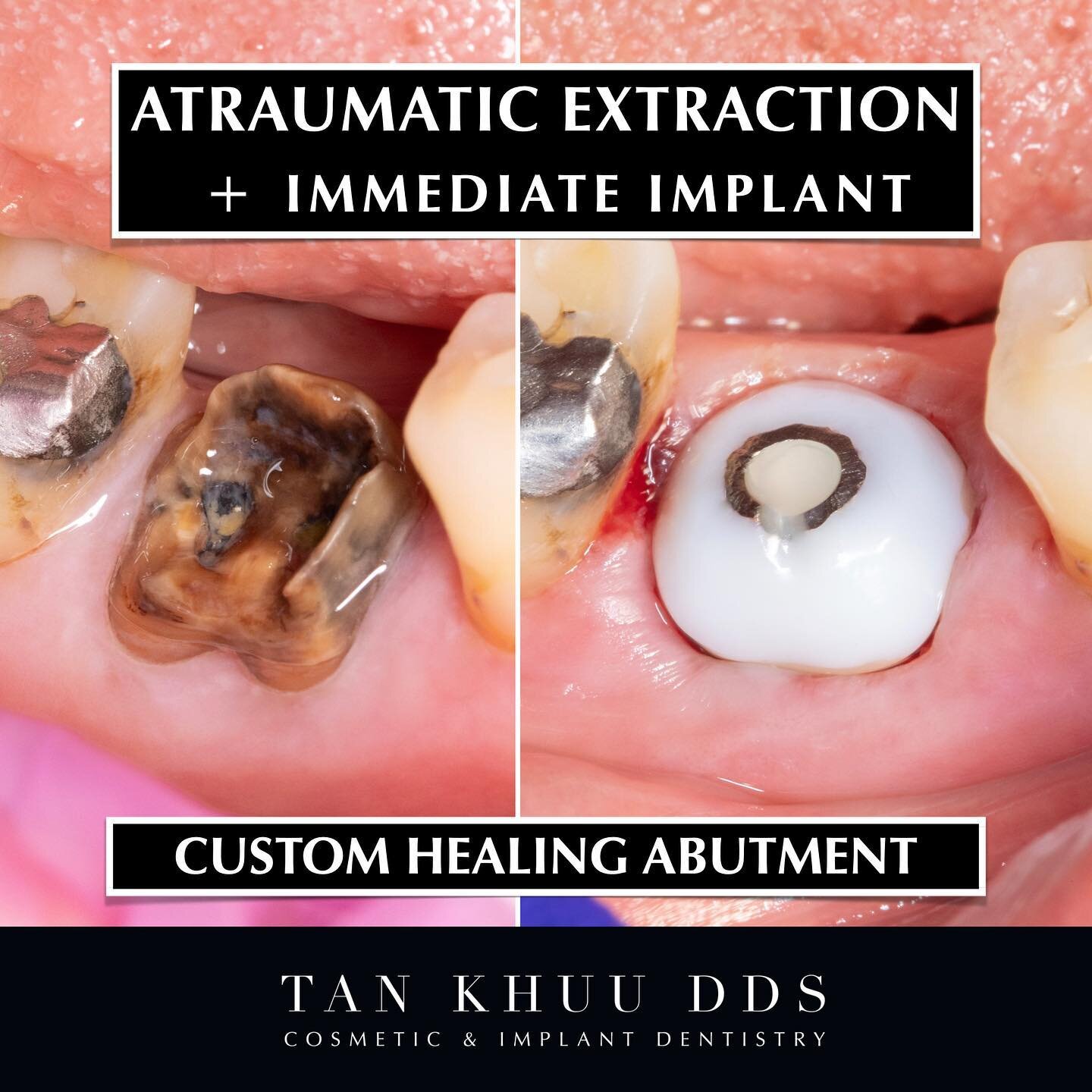 Extraction + Immediate Implant + Custom Healing Abutment

This tooth had a crown that failed years ago. It has been exposed to the oral cavity for too long and subsequently has a very poor prognosis. There was a large periapical lesion at the distal 