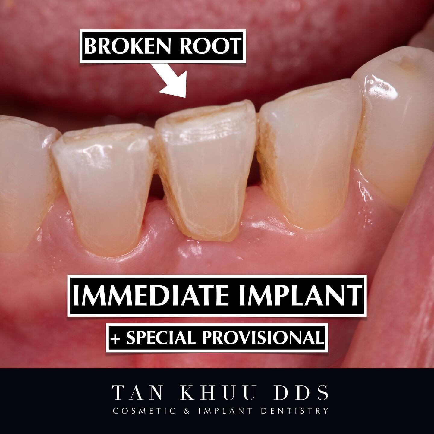 This patient suffered a broken root that extended below the bone level which made extraction necessary.

The tooth and its root were very carefully removed to preserve the bony socket for implant placement. The implant was placed deep enough to be co