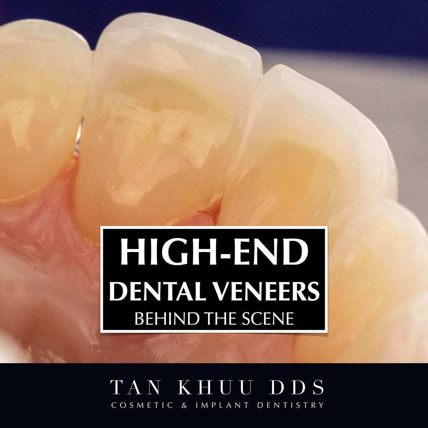 What makes a  dental veneer high-end?

High-end dental veneers are made from premium raw materials by exceptional Master Ceramists. A great amount of both time and effort is expended to produce such beautiful work. 

For example, instead of using col