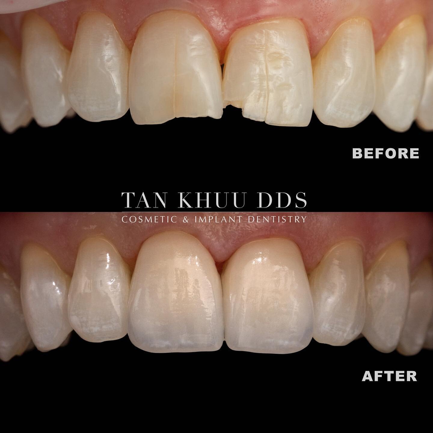 The top misconceptions about veneers:

❌ Veneers are noticeable (may look unnatural) 
❌ The process of getting veneers is painful 
❌ All veneers are made equal (not taking into account the skill of the doctor and ceramist)

Dr. Tan Khuu, DDS, special