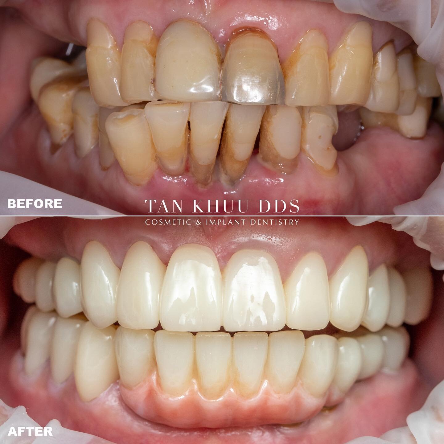 This patient was unable to eat comfortably for nearly 40 years. He came to us with teeth that were in poor condition due to infection and recurring decay. Aside from not being able to eat, he was very unhappy with how his smile looked.

His children 