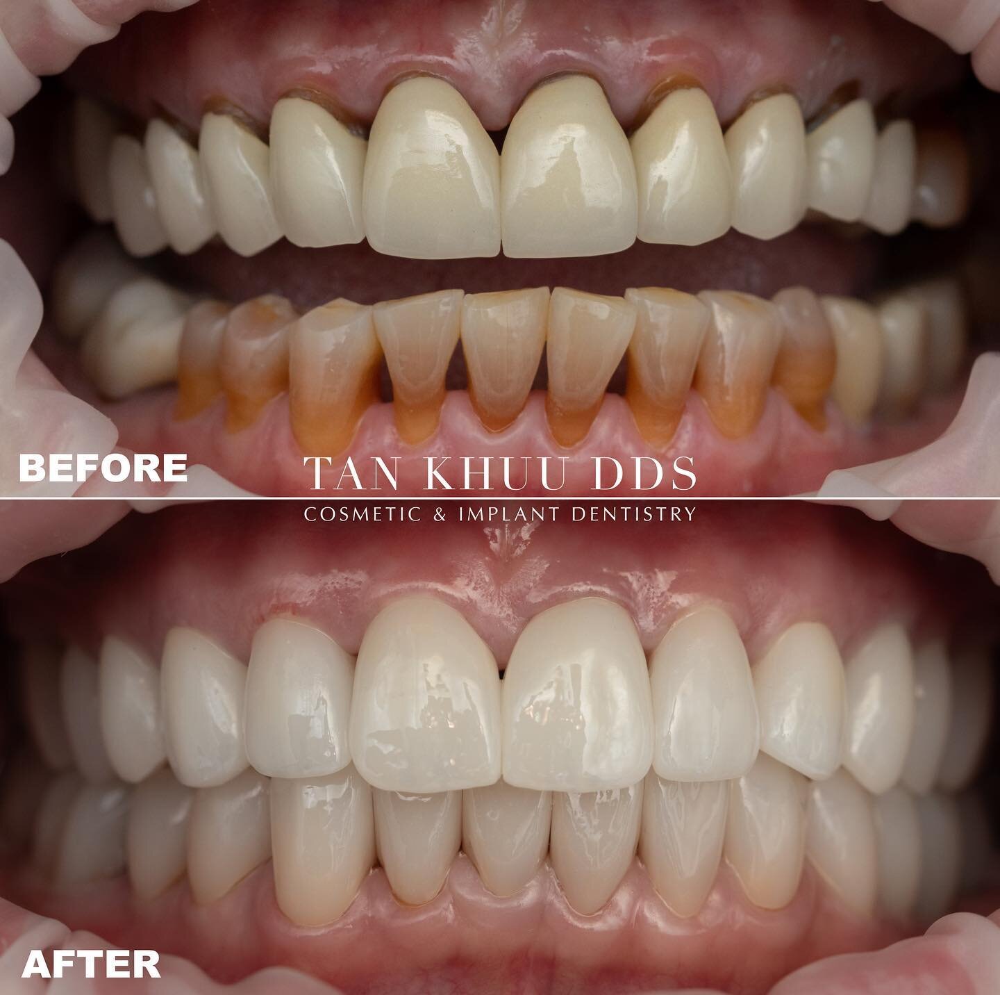 This patient came with cosmetic concerns, as well as concerns regarding the state of her existing crowns, all of which had recurrent decay at the margins after nearly 30 years of service. 

The patient was not happy with the esthetics of her current 