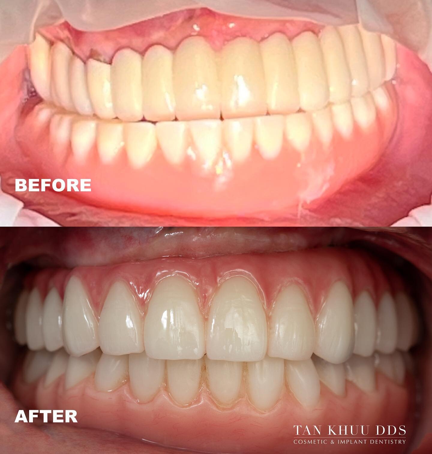This patient came into our office from out-of-state with difficulty chewing. He felt that his upper teeth were loose and complained that his lower denture kept sliding around when he tries to chew. 

Impressions of his current teeth and bite were tak