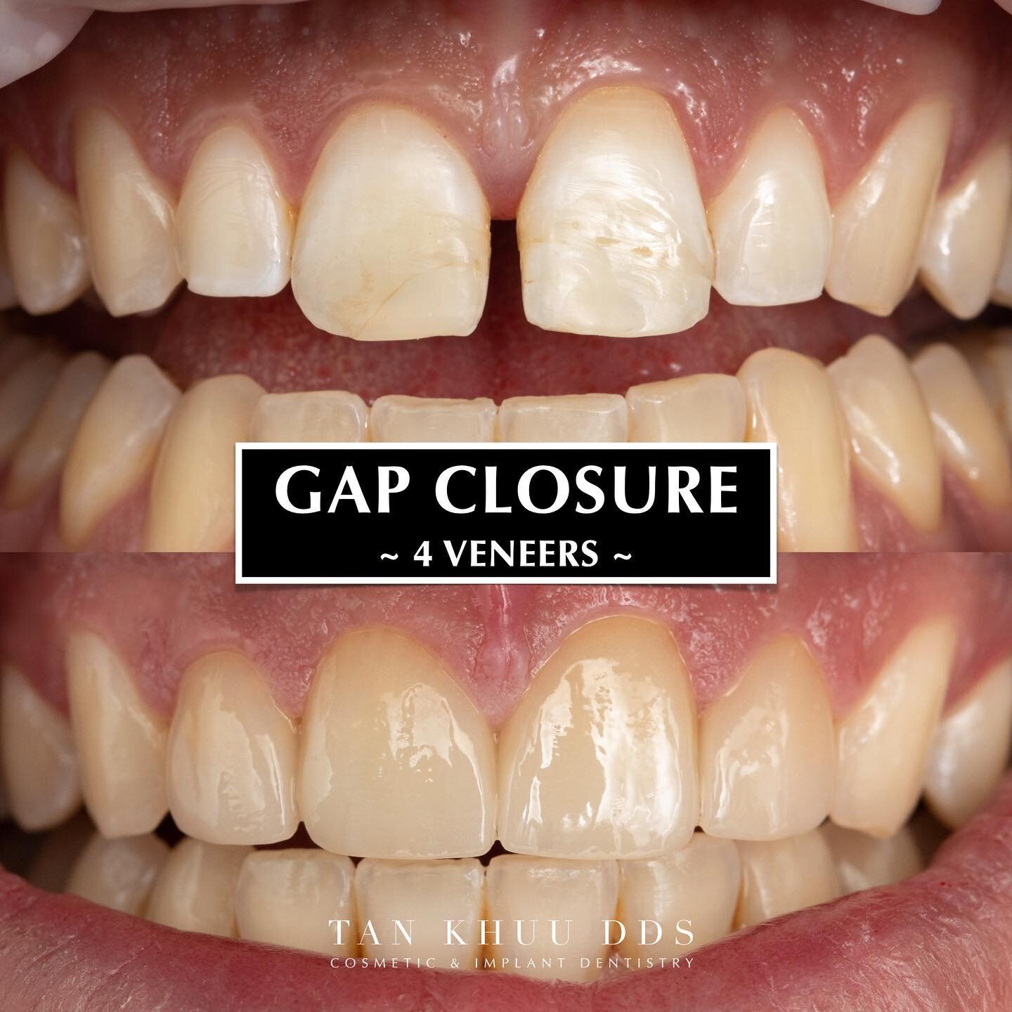 Say goodbye to gaps and hello to a stunning smile! ✨🌟 

This incredible cosmetic case was all about closing the gap between the front teeth and giving our patient the smile of their dreams. 

With a precise design of four veneers, we achieved amazin