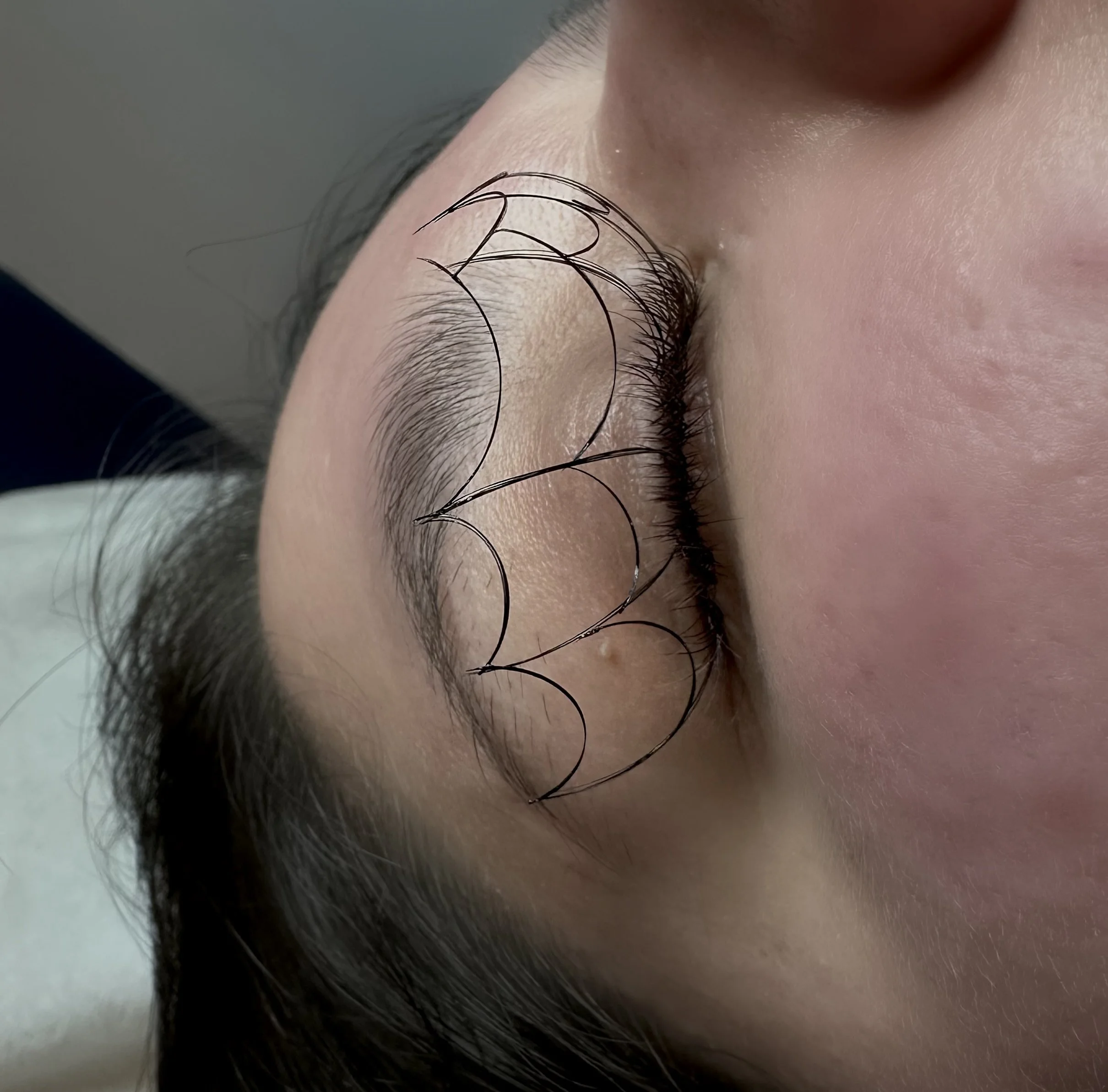 Close-up of a person's forehead and eyebrow area with several hairline stitches.
