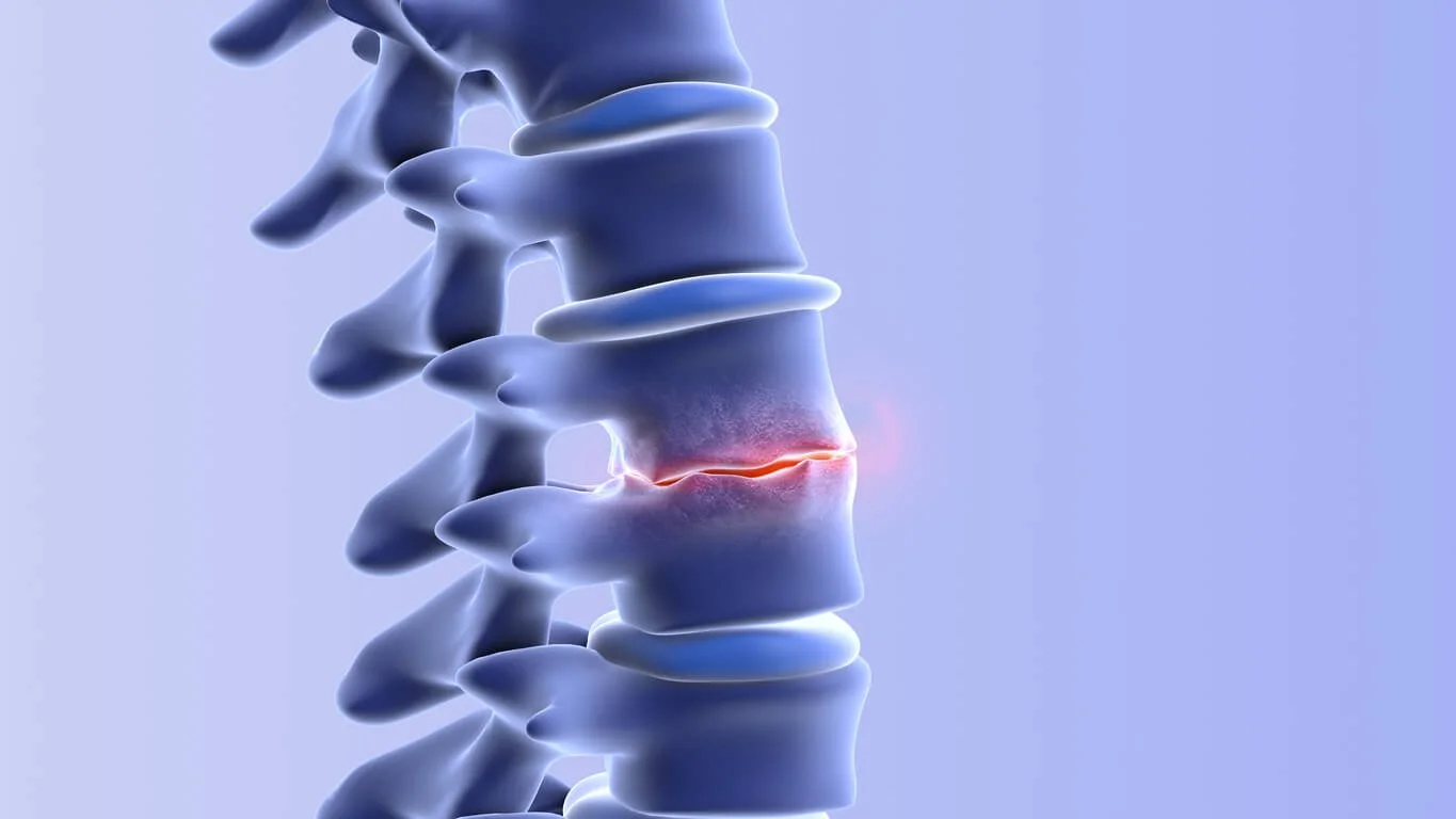 Is Spinal Stenosis a Disability? How to Qualify for Benefits