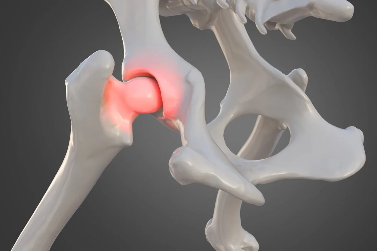 Is Hip Dysplasia a Disability? How to Qualify for Benefits