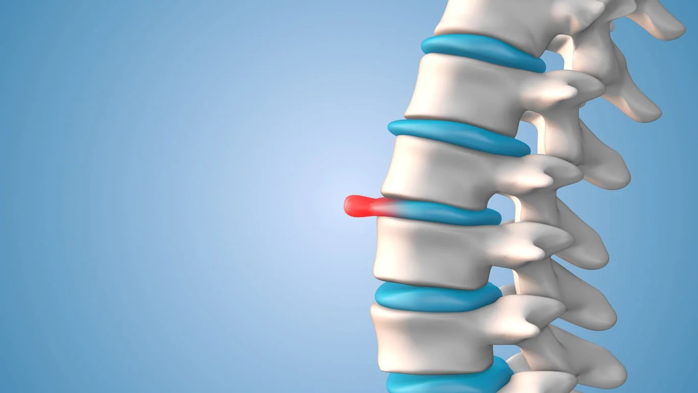 Is a Herniated Disc a Disability? Eligibility Explained