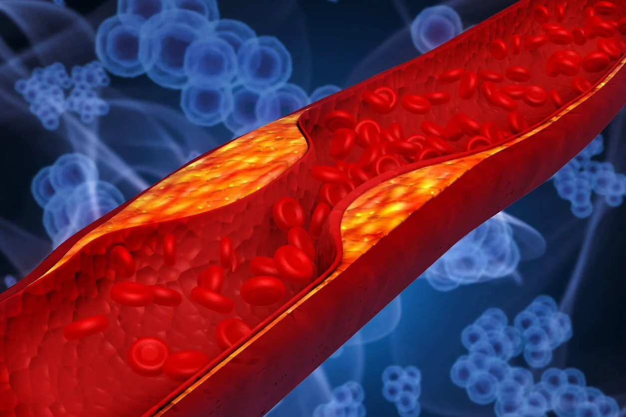 Is Coronary Artery Disease a Disability? How to Win Benefits