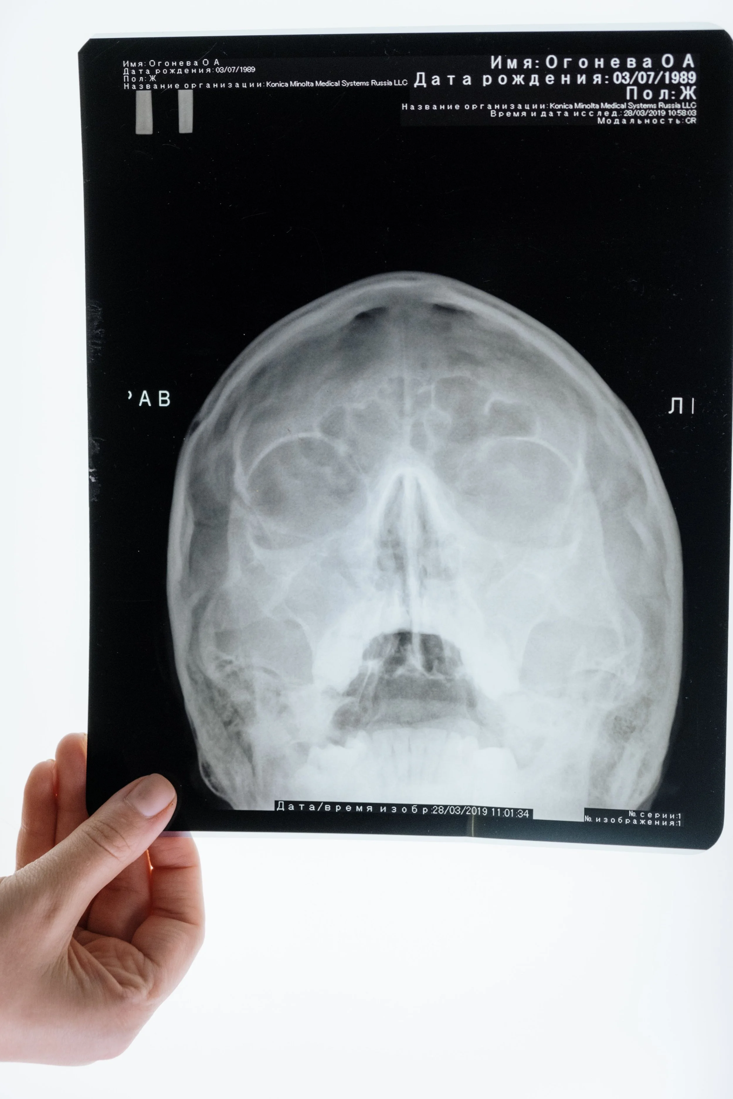 Studies of traumatic brain injury