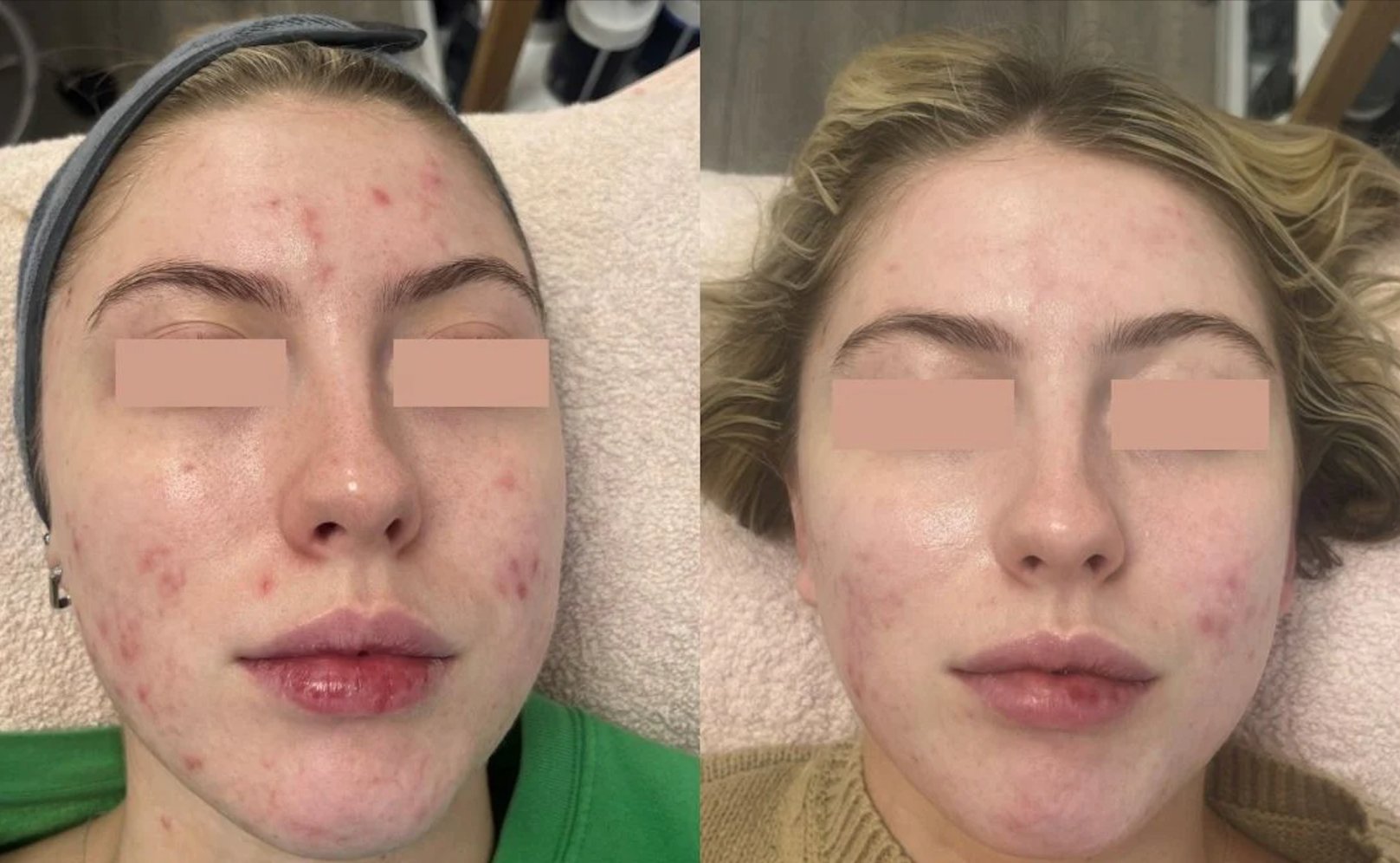 Acne Treatment Series