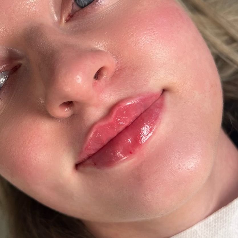Things to avoid before your lip filler appointment ❌ 

As with any injection, brushing and swelling can occur - to make your appointment more comfortable and help your lips to heal faster we advise you avoid the following - 

One week before - 
- Asp