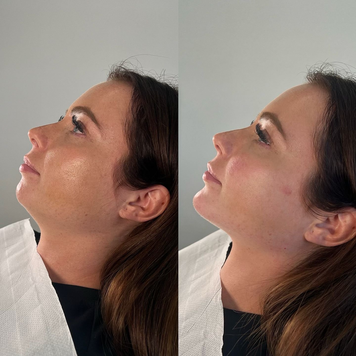 3ml Package 💉 

We used to dermal filler to add length to the chin and enhance the jawline. 
We also contoured the cheek and added volume to the midface. Creating a more defined, lifted look to the face. 

Visit us for a free consultation to discuss