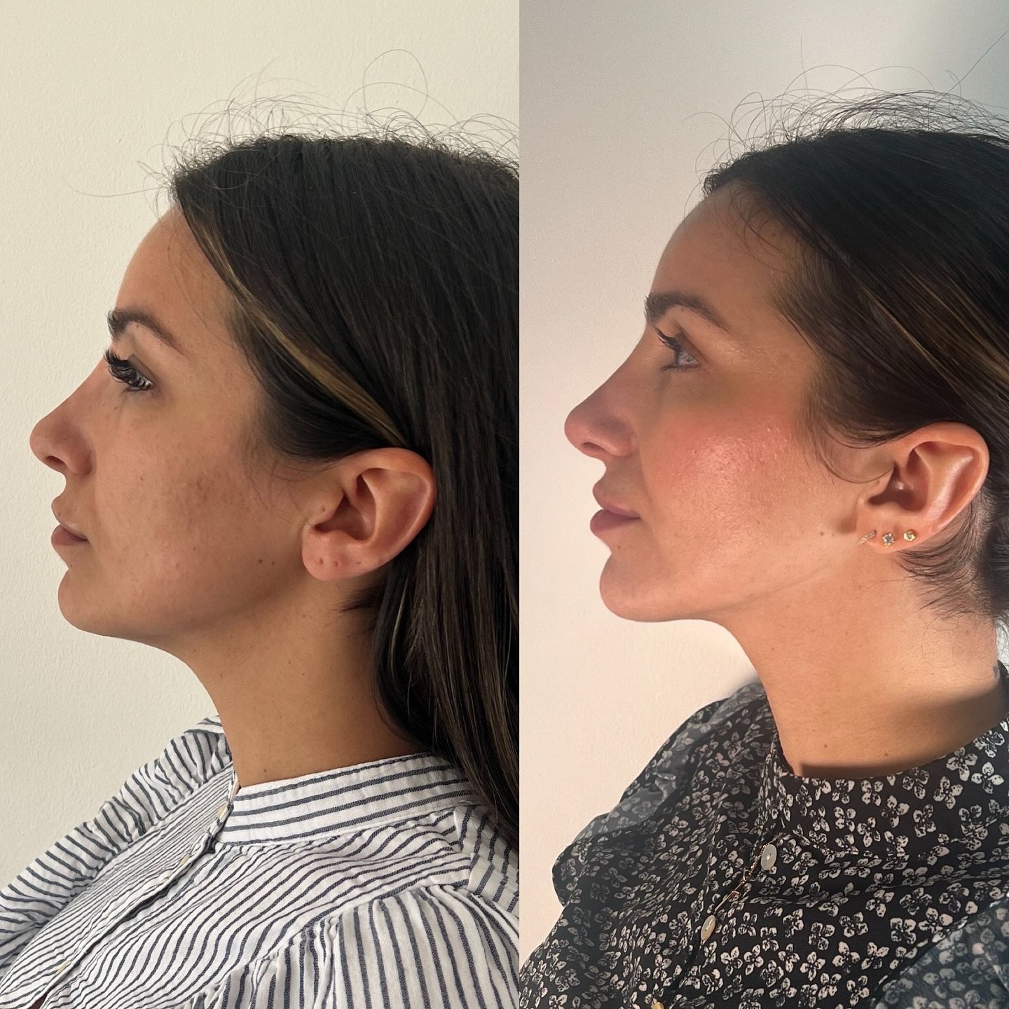 Lower face HIFU results 📐 

Lower face HIFU (High-Intensity Focused Ultrasound) is a non-invasive cosmetic procedure that targets the deeper layers of skin and underlying tissues to lift, tighten, and rejuvenate the lower face. 

During the procedur