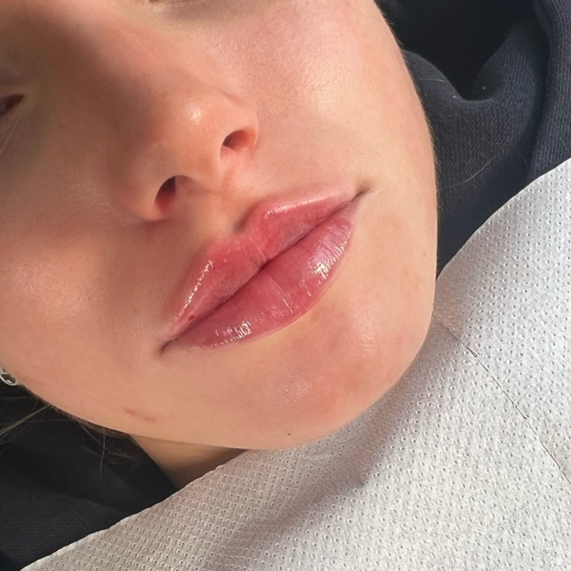 You lips&hellip; only better 😍 

📍 56a Allerton Road, Liverpool, L18 1LW 
📍 Unit 8, Kings Eight, St James Rd, Brentwood CM14 4LF
🖥️ Njsaesthetics.com
📲 WhatsApp +44 7935 707645
🗣️ DM all enquiries
📩 Link in bio for all bookings 

#aesthetics #