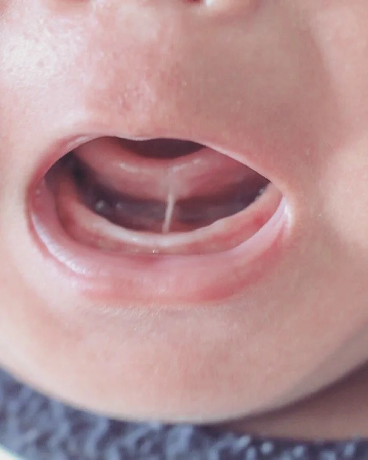 Et klip af tungeb&aring;nd kan ikke st&aring; alene.

Et stramt tungeb&aring;nd er ikke kun et sp&oslash;rgsm&aring;l om et lille stykke v&aelig;v. Det er et funktionelt problem, der har p&aring;virket barnets bev&aelig;gelse, sp&aelig;ndingsm&oslash