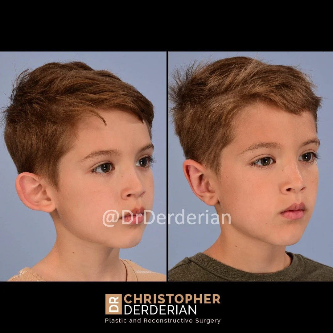 before and after otoplasty case 9 right 3/4