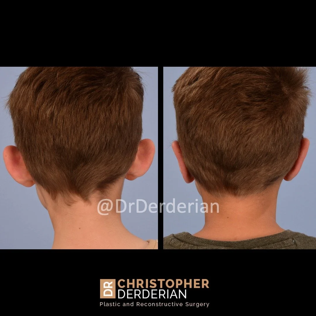 before and after otoplasty case 9 behind view