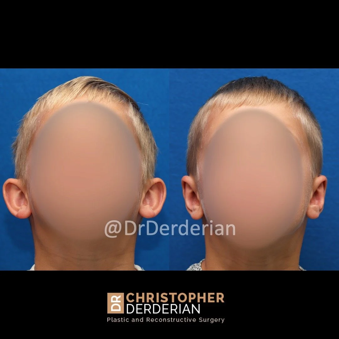 before and after photo otoplasty below 3/4 view