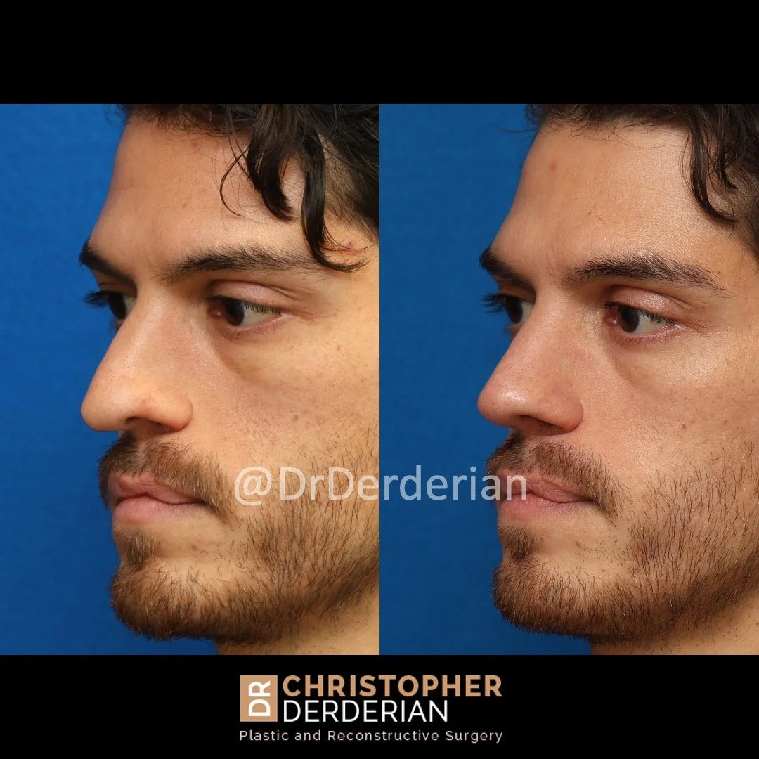 Before and after cleft rhinoplasty left 3/4