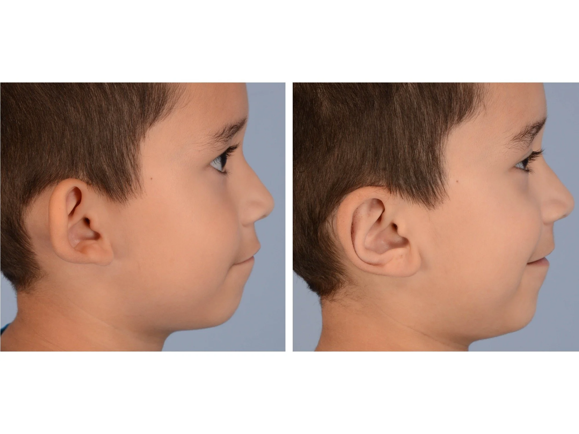 before and after otoplasty case 4 right lateral